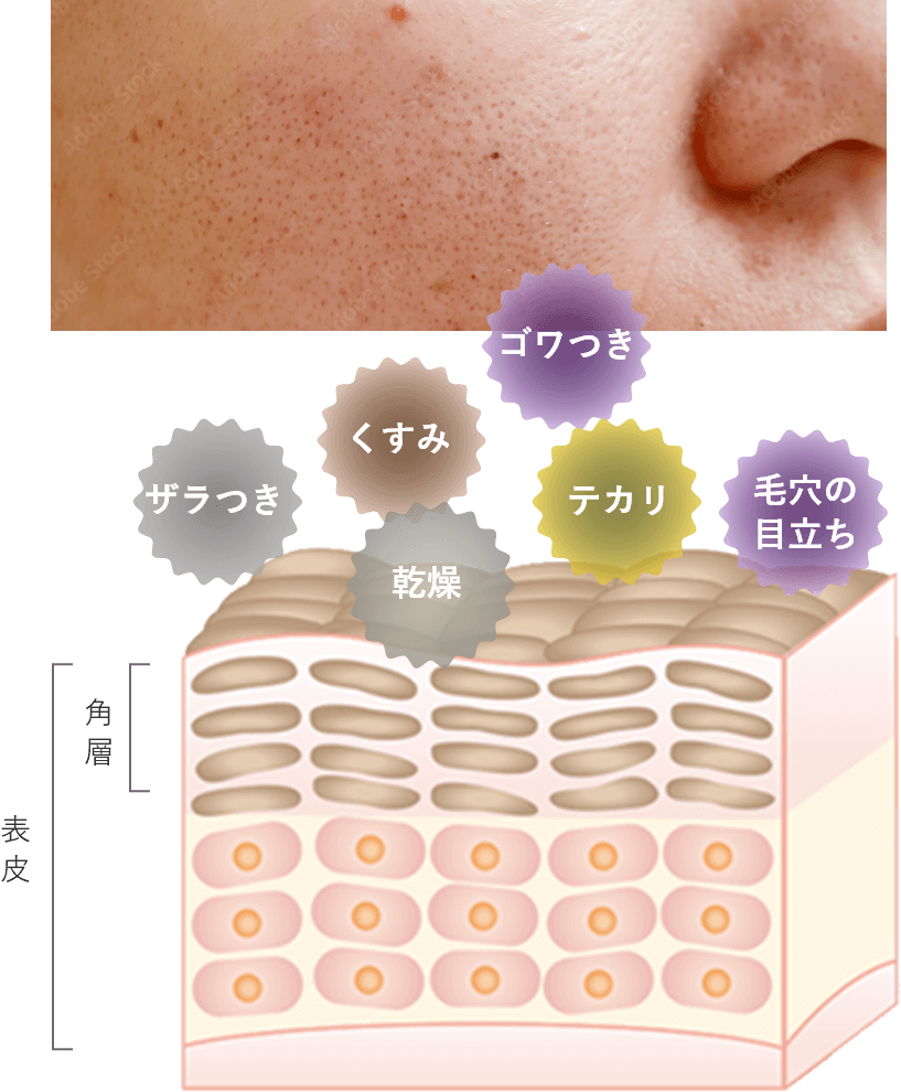 肌トラブルの肌図